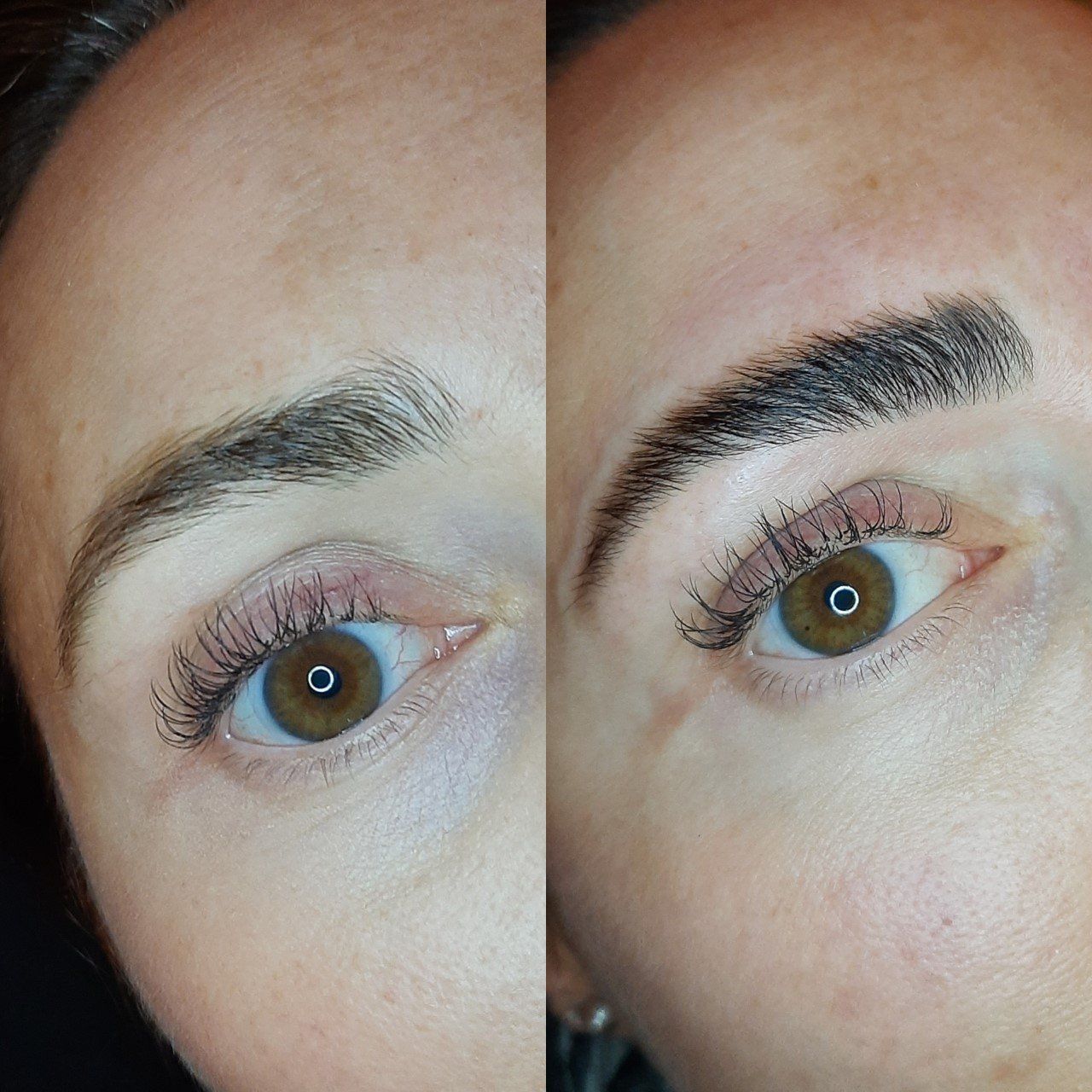 brow lifting schalkwijk