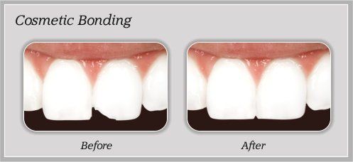 Cosmetic Bonding Before & After