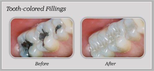 Tooth Colored Fillings Before & After