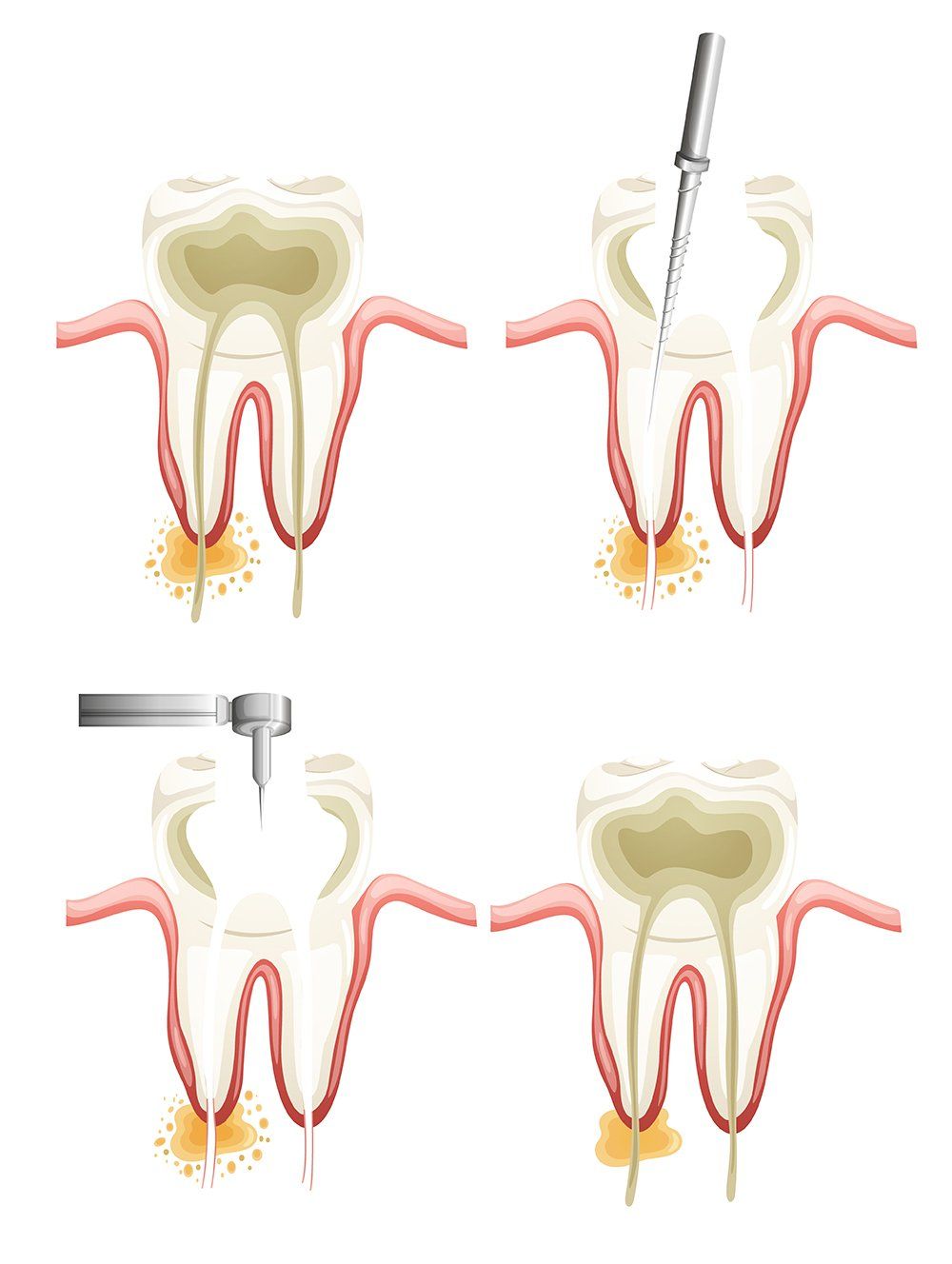 Root Canal Treatment Pinole, CA