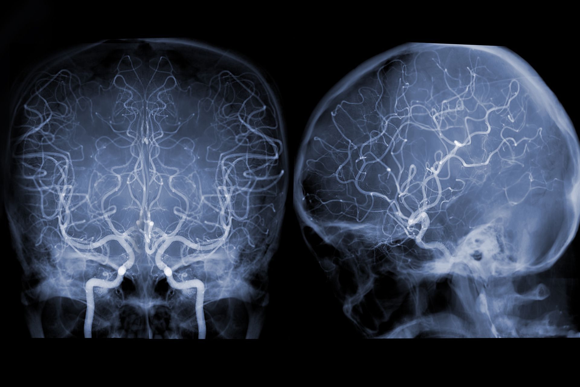 Cerebral angiography image from fluoroscopy in interventional radiology.
