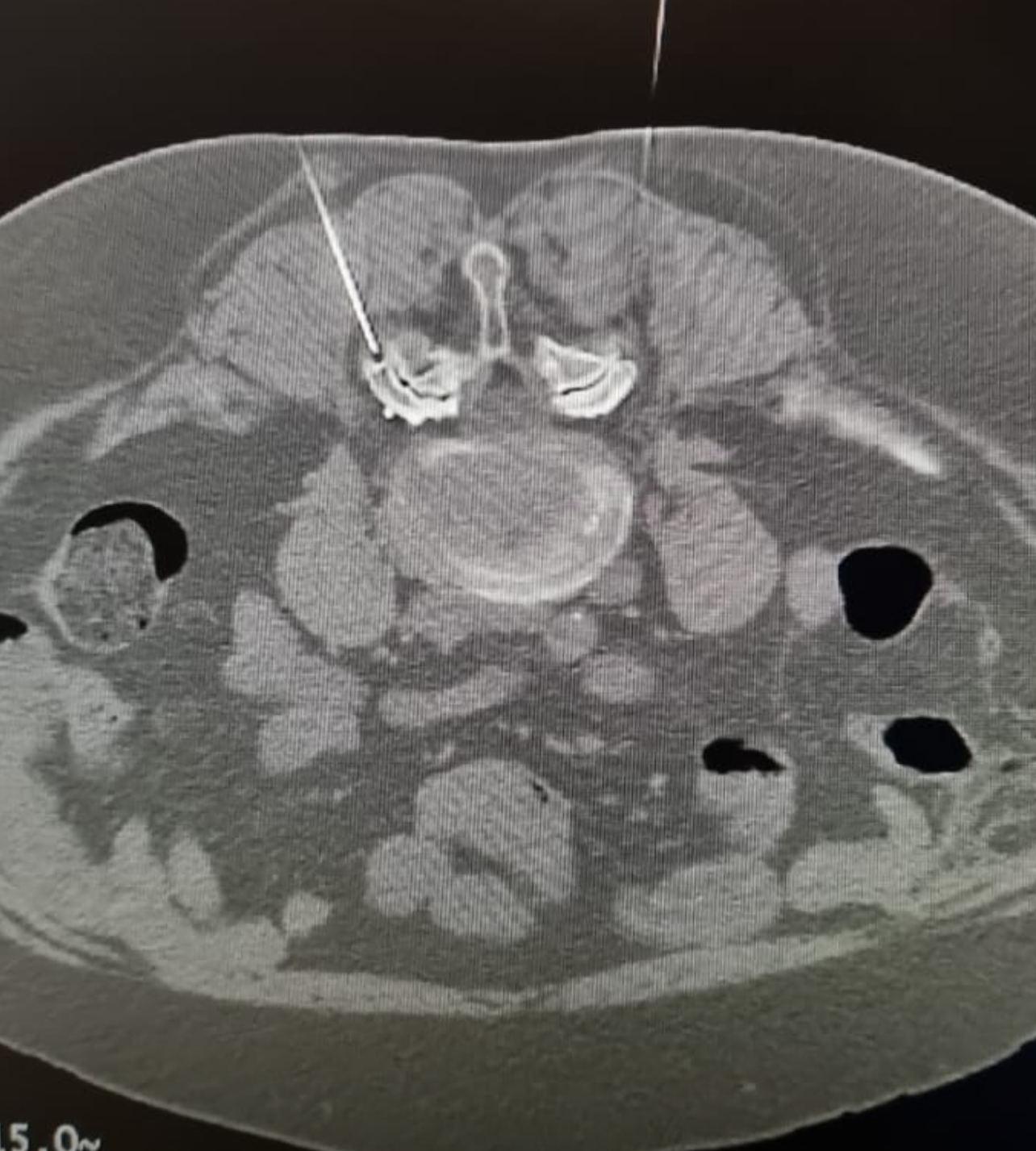 A woman is getting an ultrasound on her stomach.