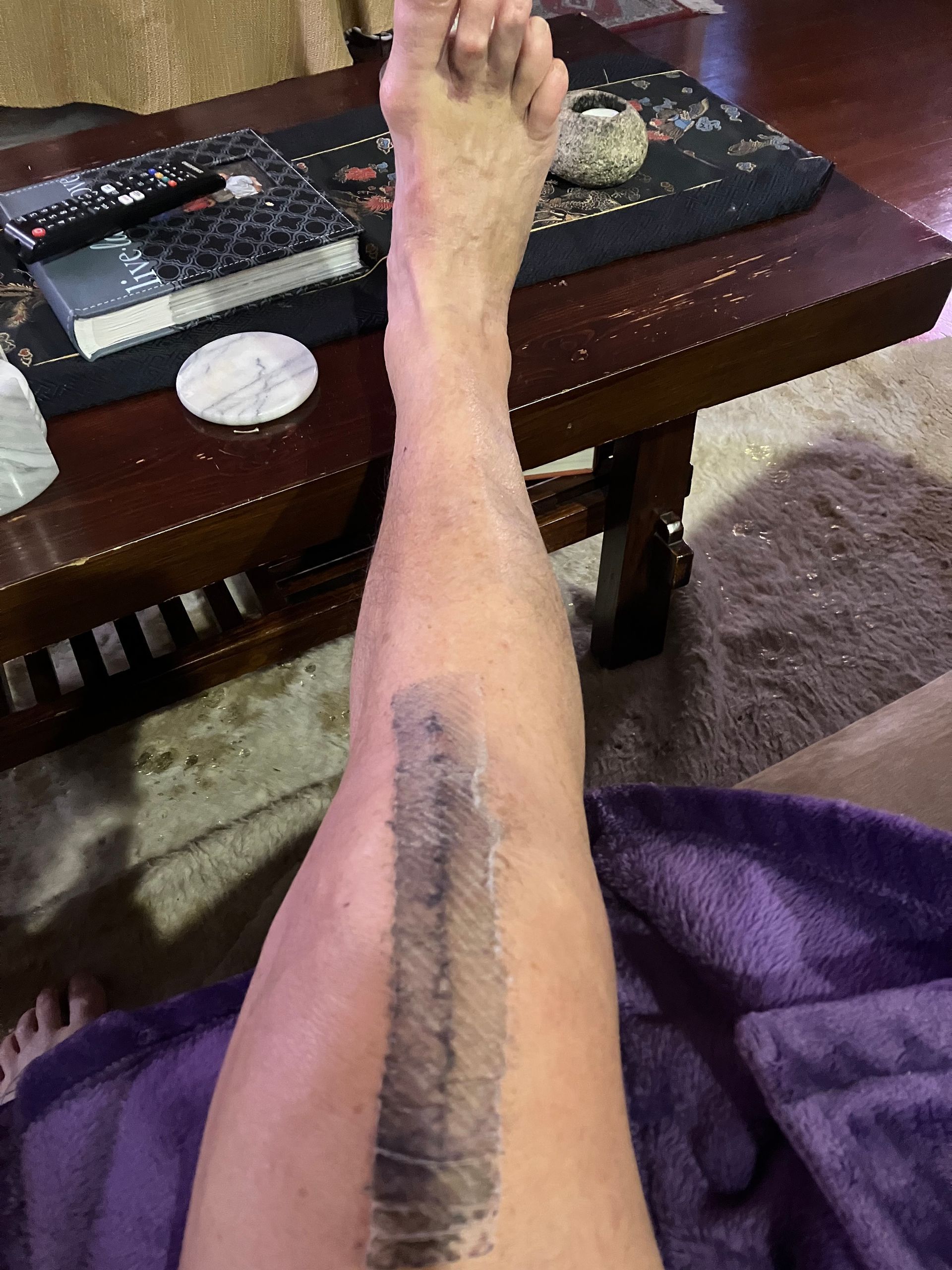 A person is laying on a purple blanket with a surgical scar on their leg.