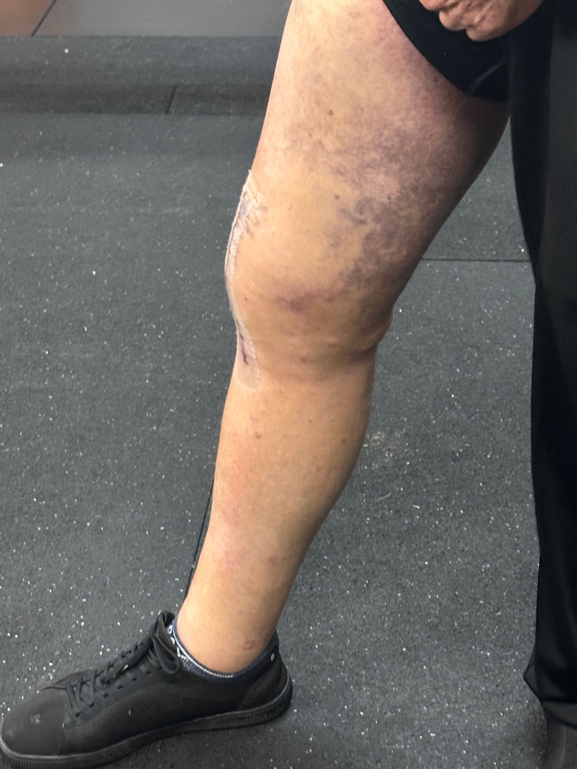 A person with varicose veins on their leg is wearing black shoes.