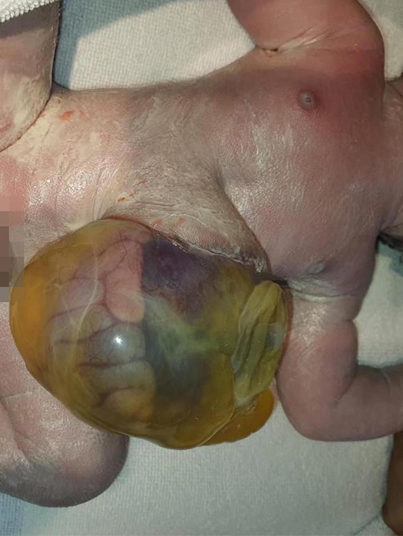Born with exomphalos