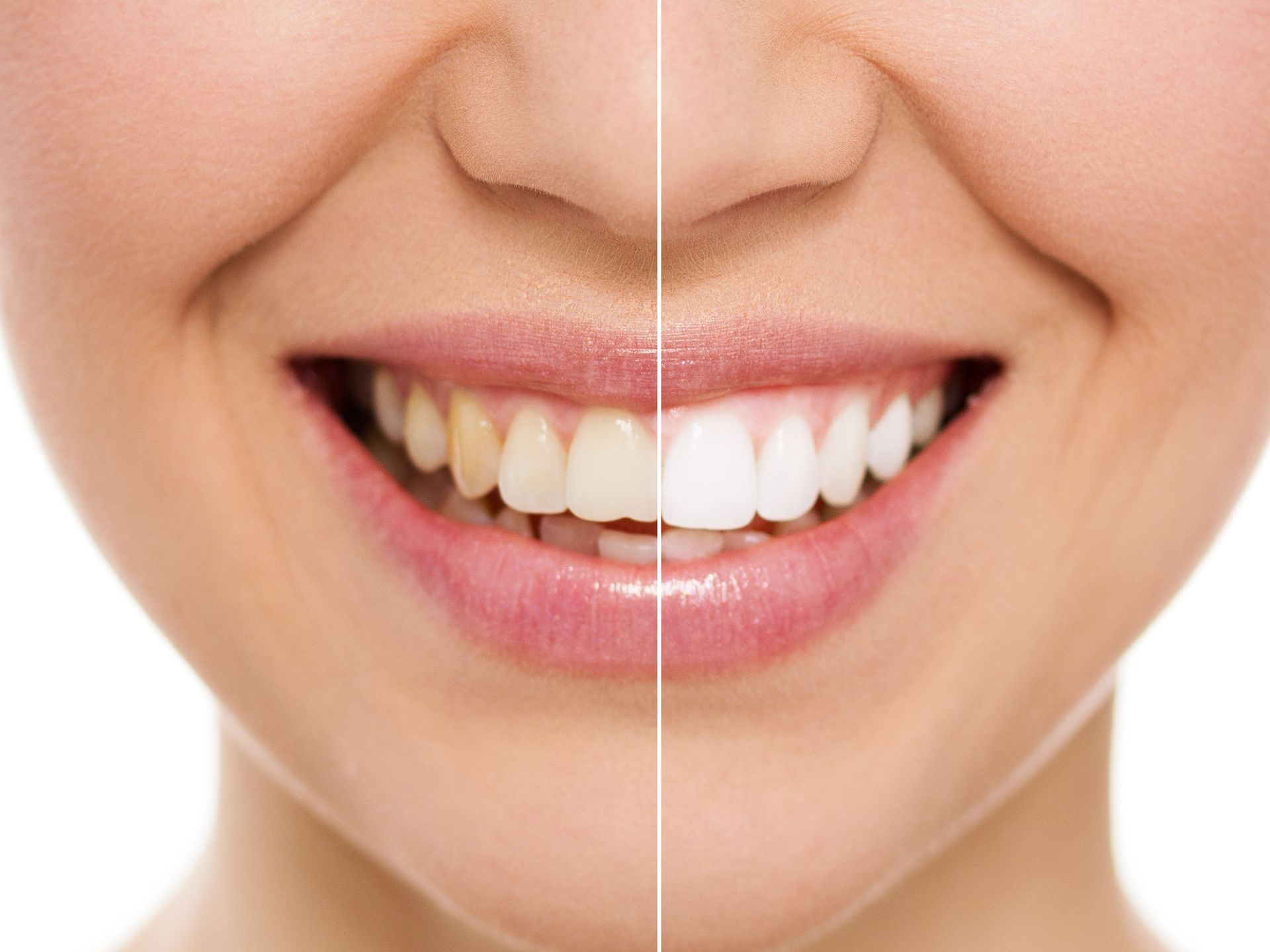 Teeth whitening image