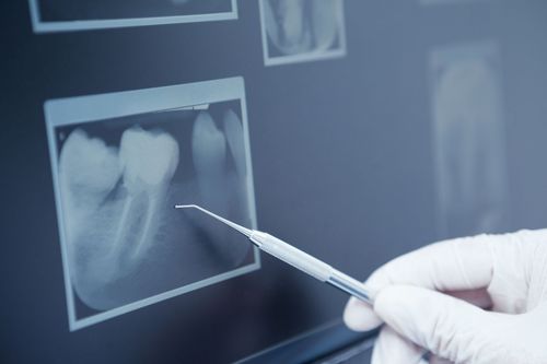 root canal xray image