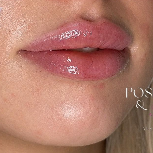 Lips after filler