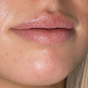 Lips before filler