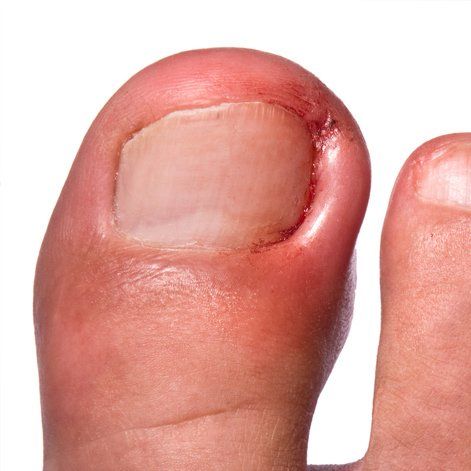 ingrown toenail