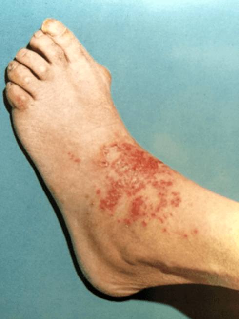 dermatite allergica da contatto