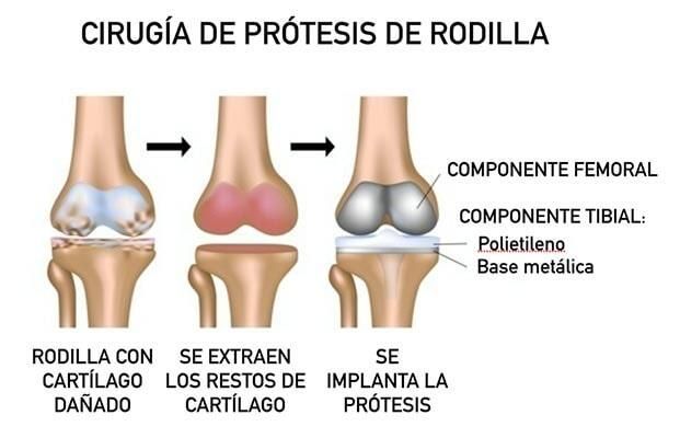 DR JORGE DE LA VEGA - PROTESIS DE RODILLA