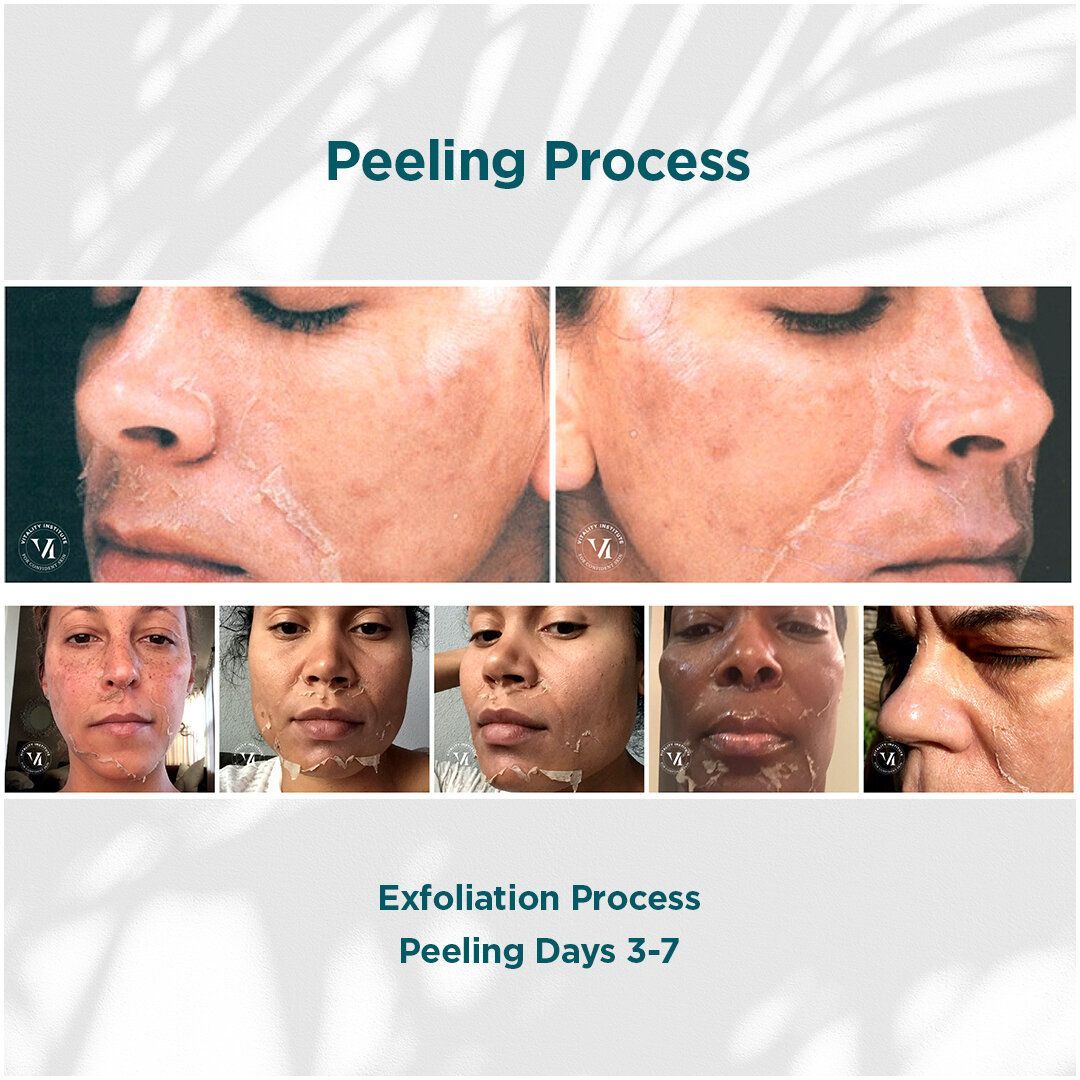 A woman 's face is shown before and after a peeling process.