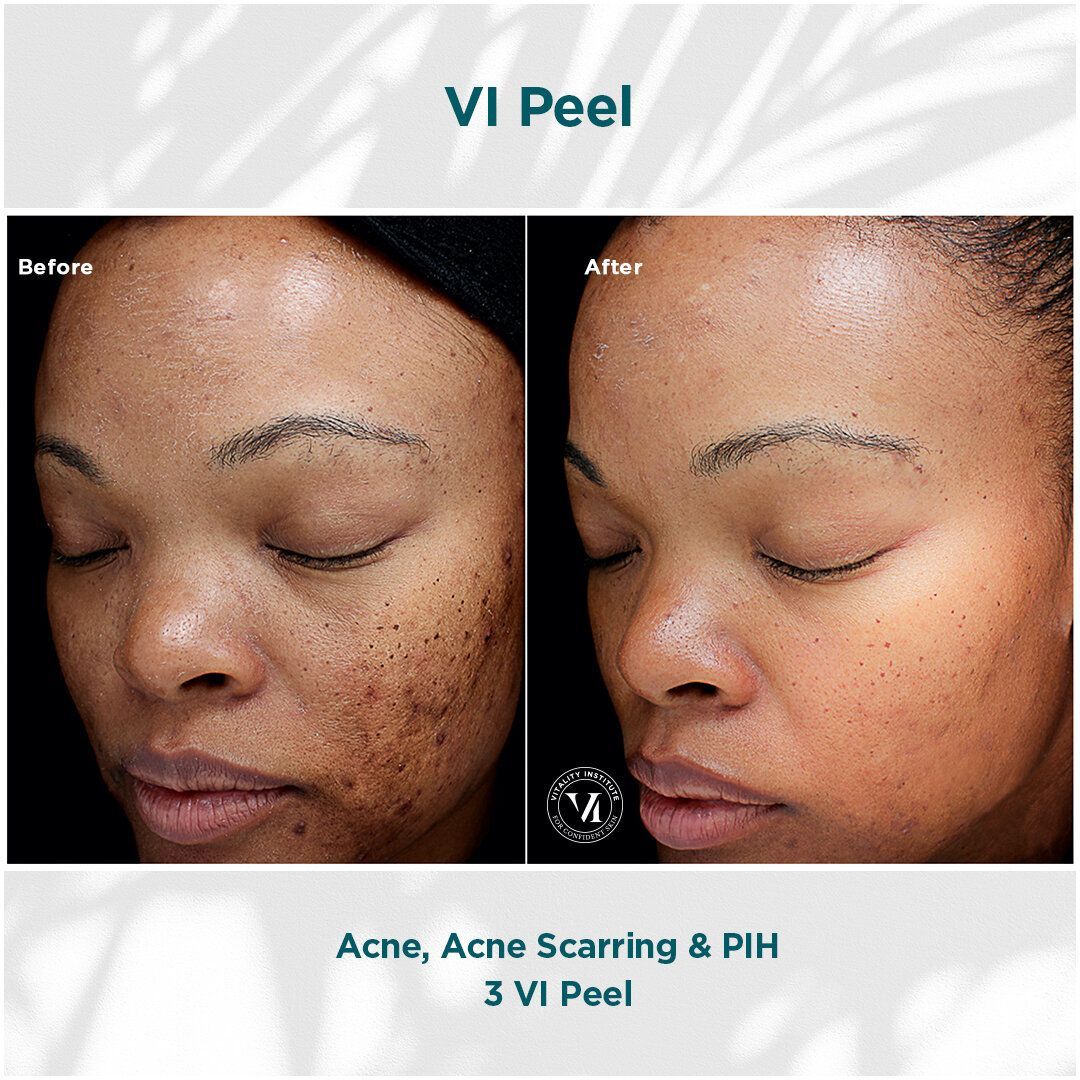 A woman 's face before and after a vi peel treatment