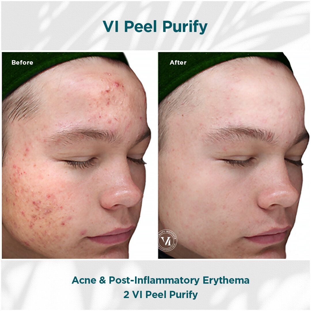 A before and after picture of a person 's face with acne and post-inflammatory erythema