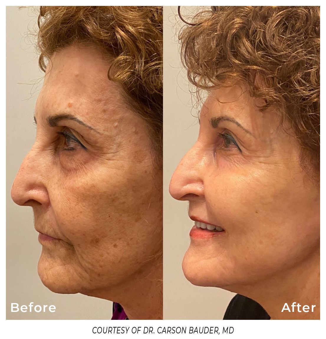 A before and after photo of a woman 's face