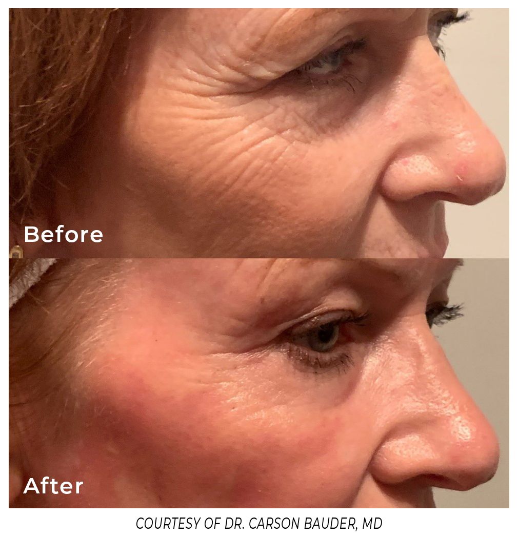 CO2 Skin Resurfacing treatment at Omorphia Aesthetics to reduce wrinkles and rejuvenate skin.