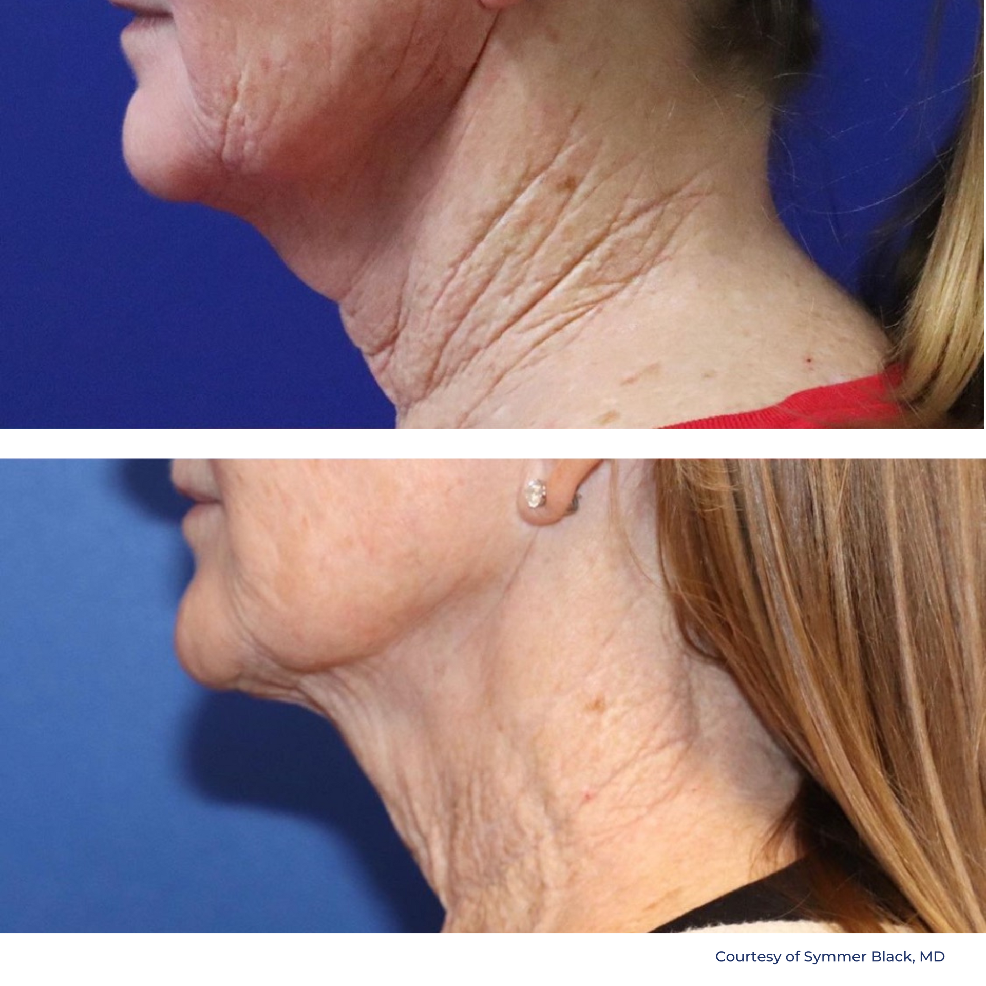 A before and after photo of a woman 's neck and face