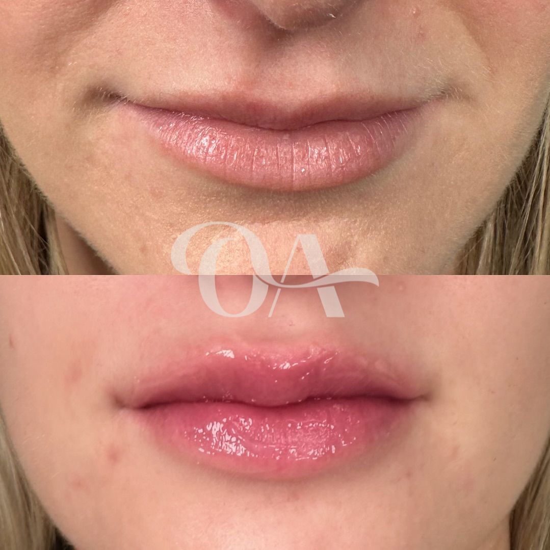 A before and after photo of a woman 's lips.