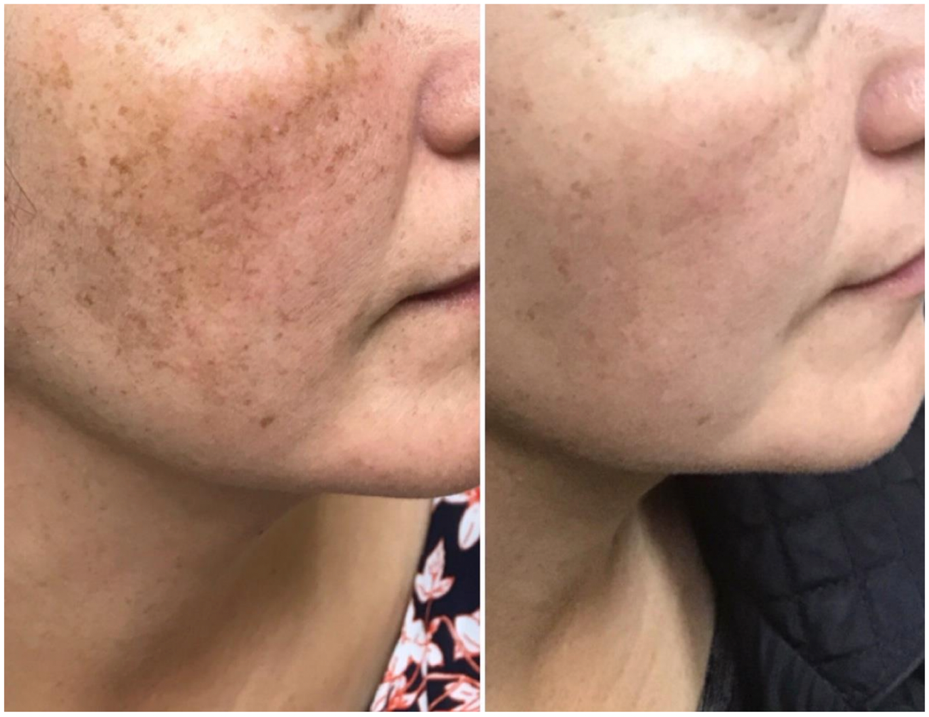 Before and after photos of PicoLazer skin treatment showing improvement in skin tone & texture 