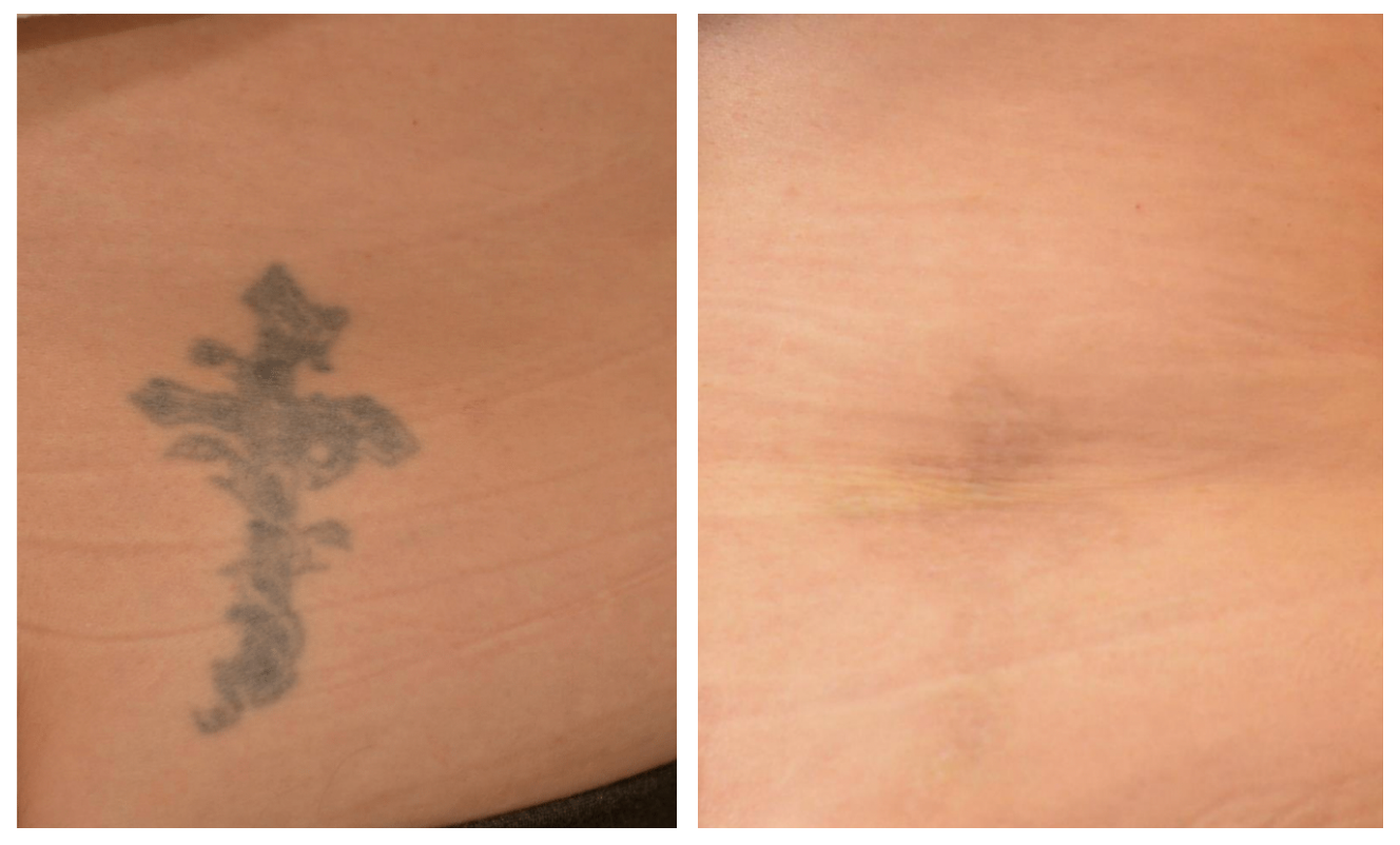 A before and after picture of a tattoo on a person 's skin.