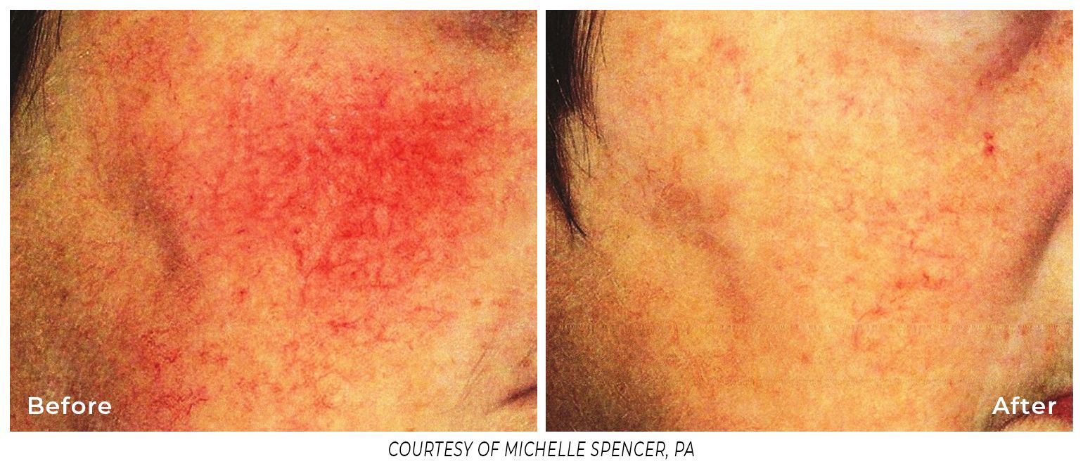 A before and after photo of a person 's face with red spots