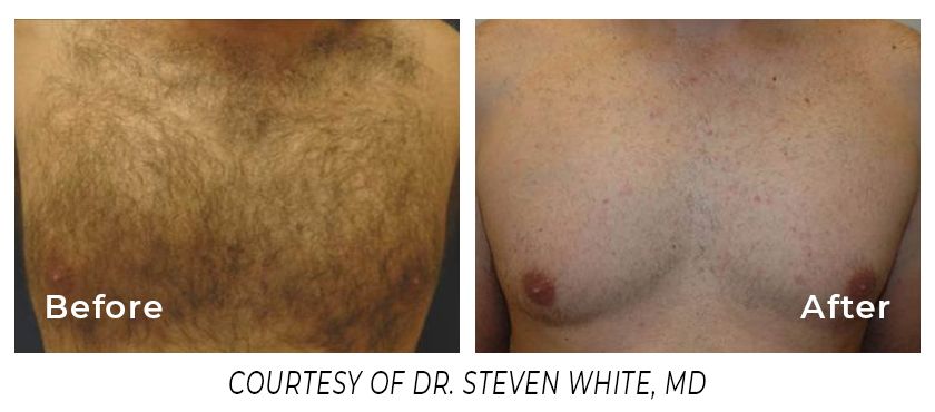 A before and after photo of a man 's chest by dr. steven white md