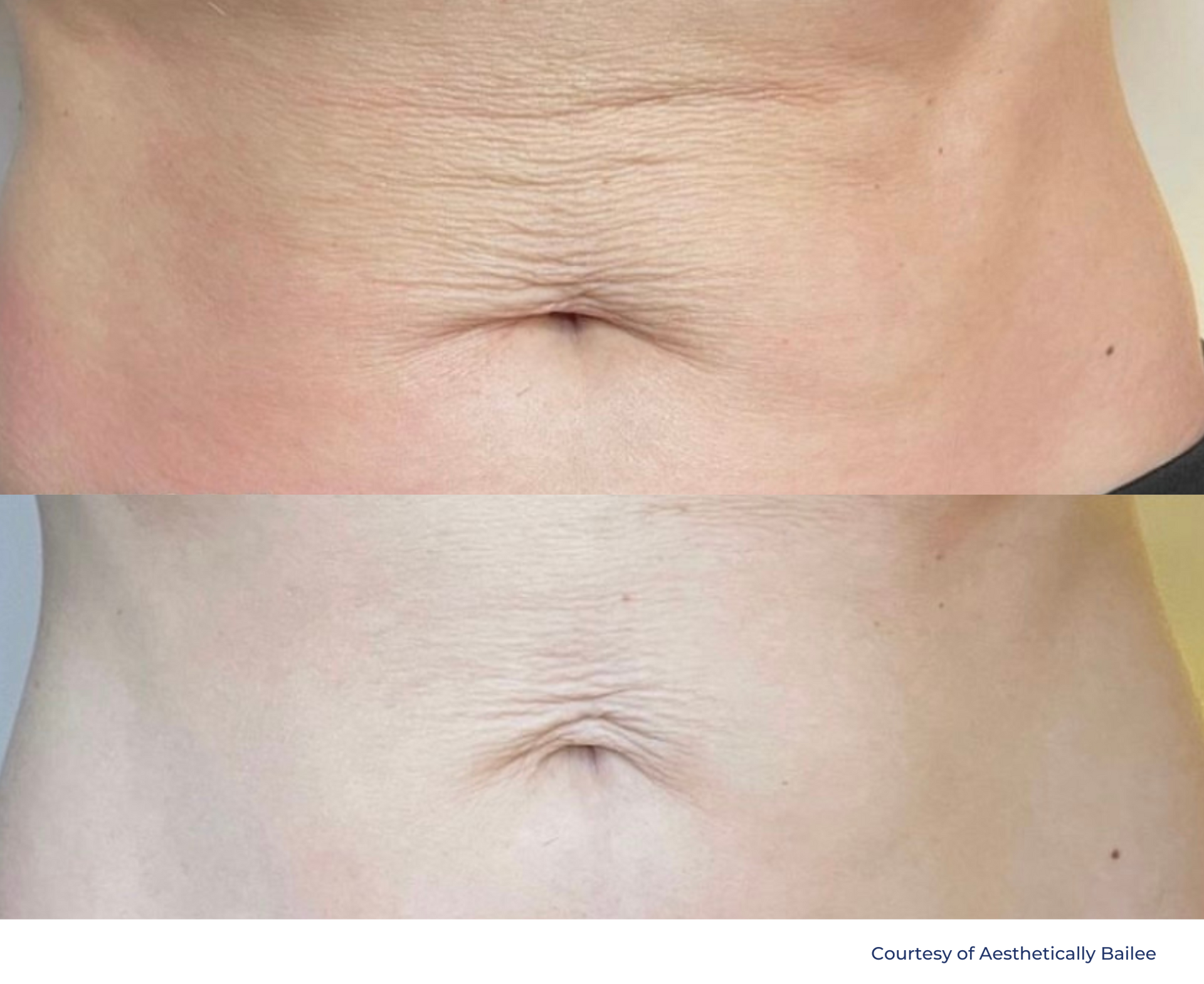 A before and after picture of a woman 's stomach with wrinkles.