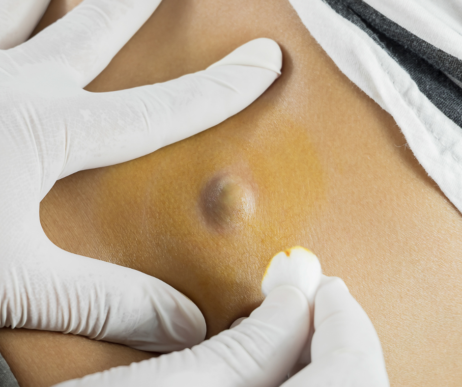 picture of gloved hands preparing an abscess for treatment