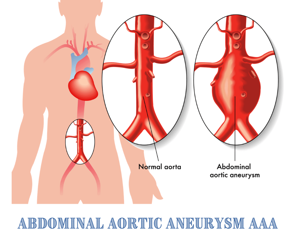 Sunrise Hospital. A woman died from an abdominal aortic aneurysm because Sunrise Hospital kept delaying and canceling her surgery and also delayed her transfer to a better hospital.