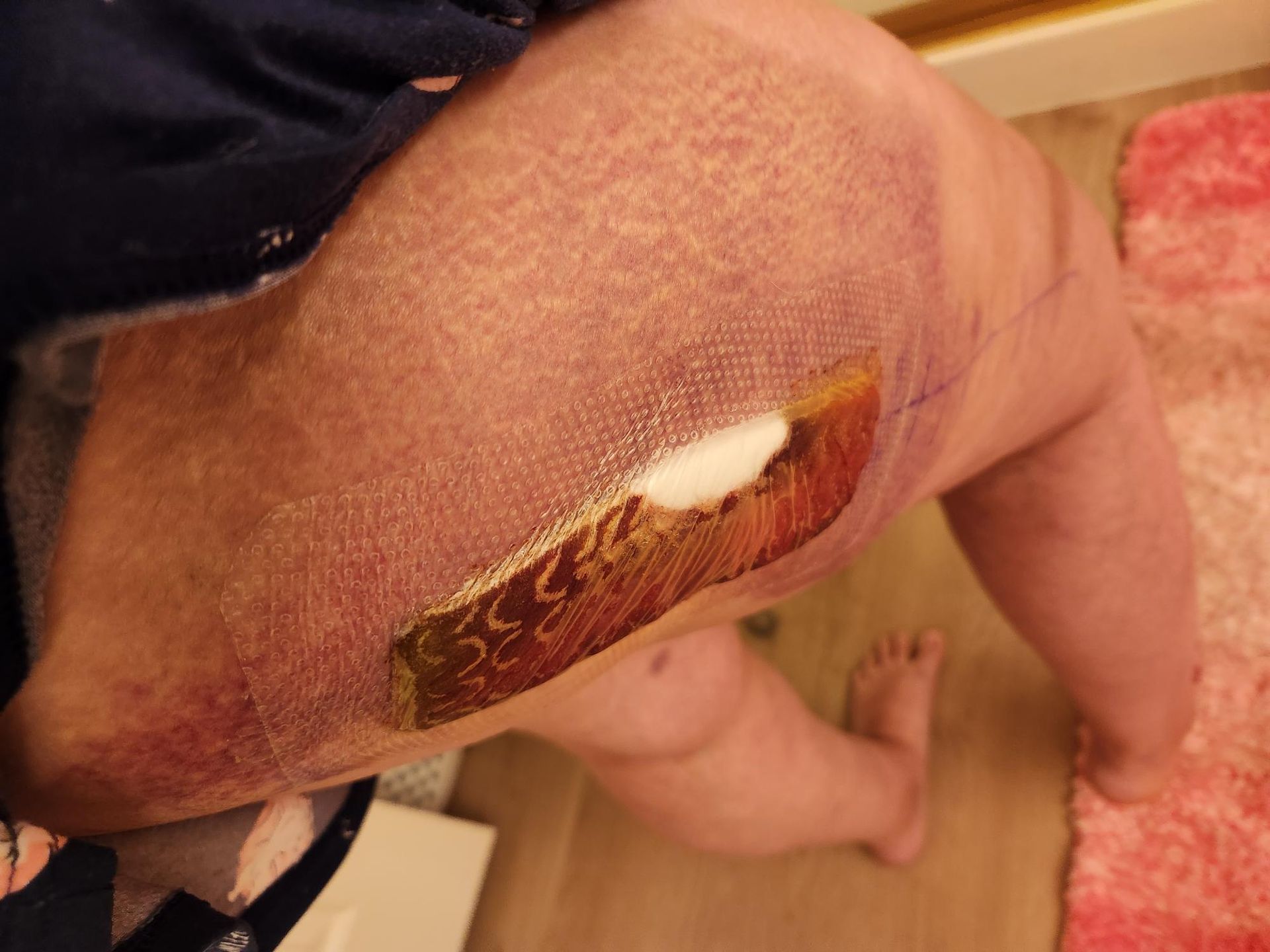 Sunrise Hospital and Michael Bradford MD_botched hip replacement_pic 1