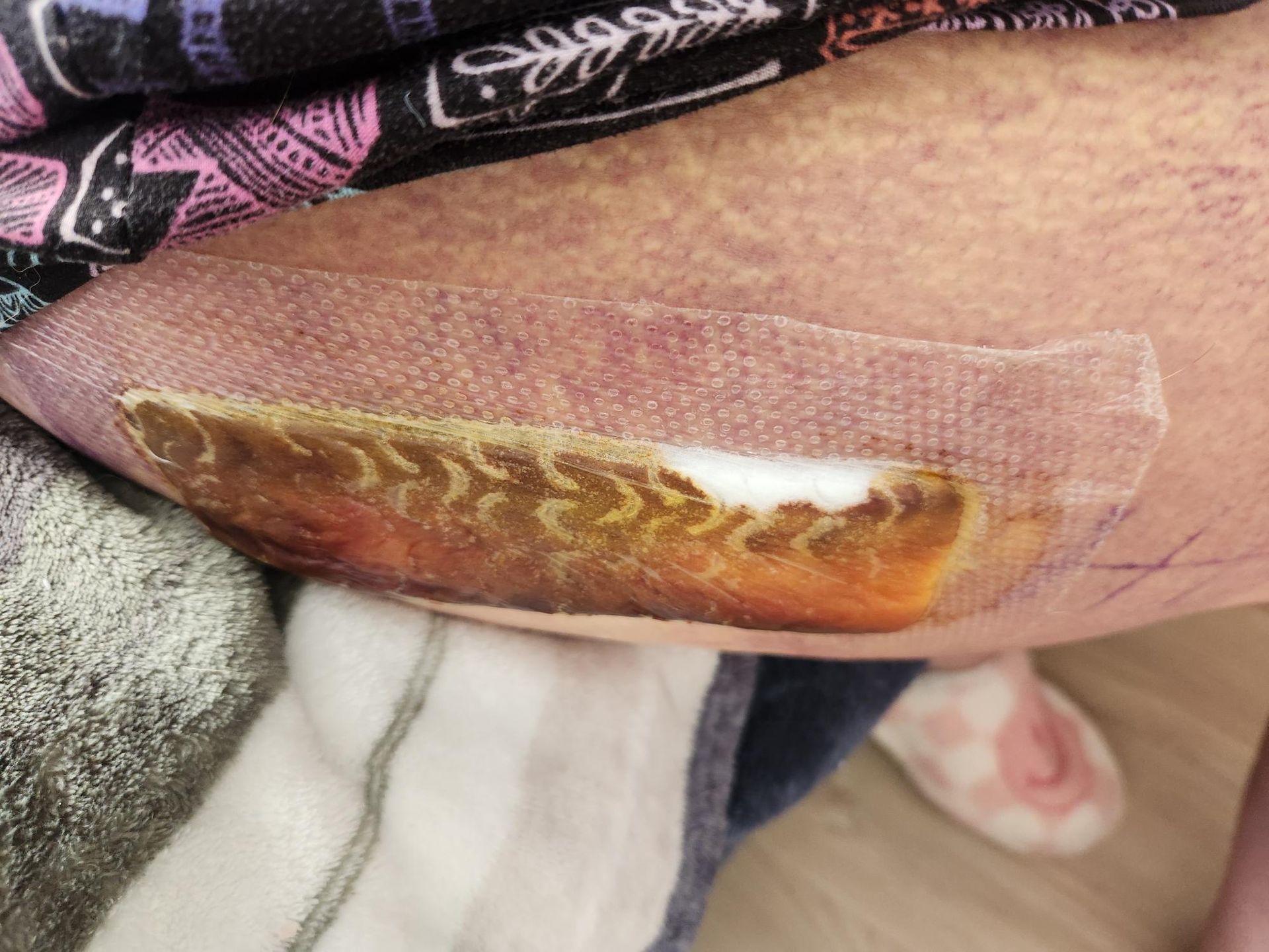 Sunrise Hospital and Dr Michael Bradford-botched hip replacement-pic 2