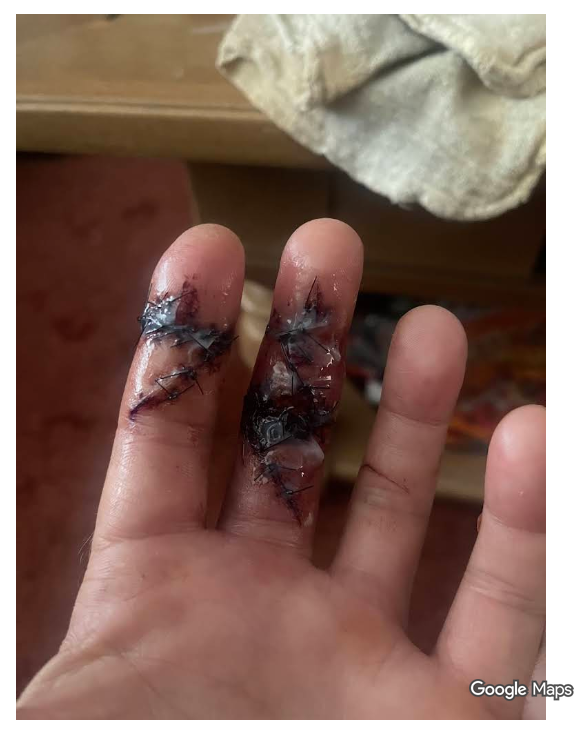 Sunrise Hospital. Patient-106 had an unsuccessful surgery by Dr. Kevin Golshani at Nevada Orthopedic.