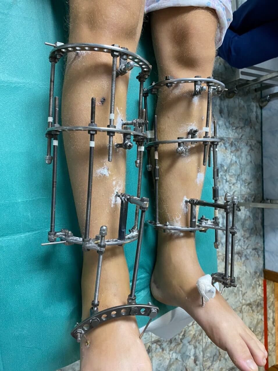 Sunrise Hospital. Patient-111. Stock photo of a man who had leg lengthening surgery.