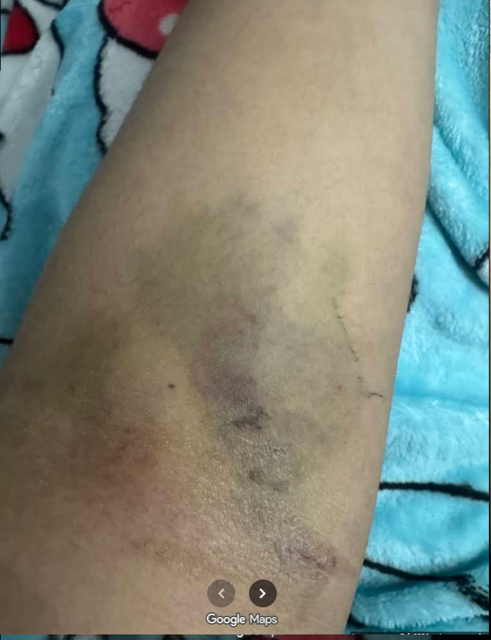 Sunrise Hospital, photo of Patient-184's damaged arm due to bad placement of IVs