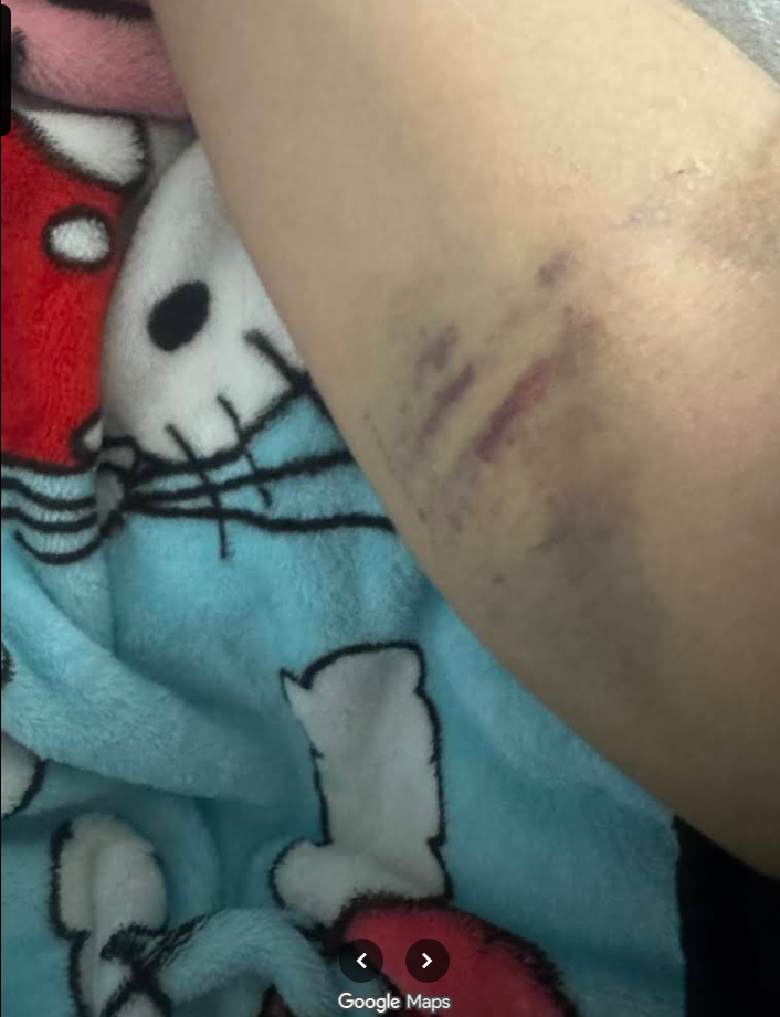 Sunrise Hospital, photo of Patient-184's damaged arm due to bad placement of IVs