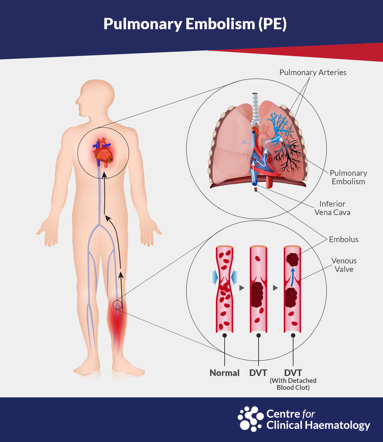 Sunrise Hospital. Stock photo illustrating DVT and pulmonary embolism. Sunrise Hospital. Stock photo illustrating DVT and pulmonary embolism.