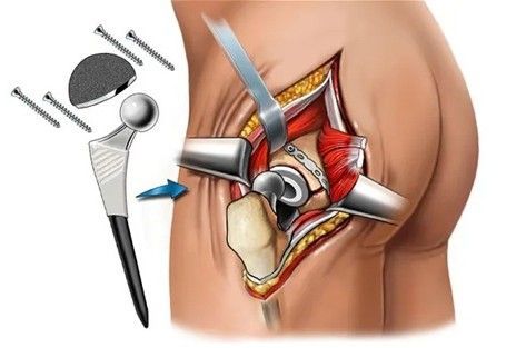 Sunrise Hospital. Patient-15, diagram of hip replacement surgery