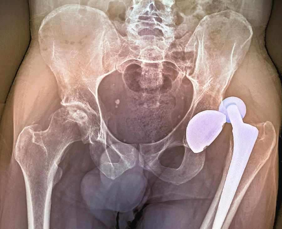 Sunrise Hospital. Patient-16, stock photo of dislocated hip replacement