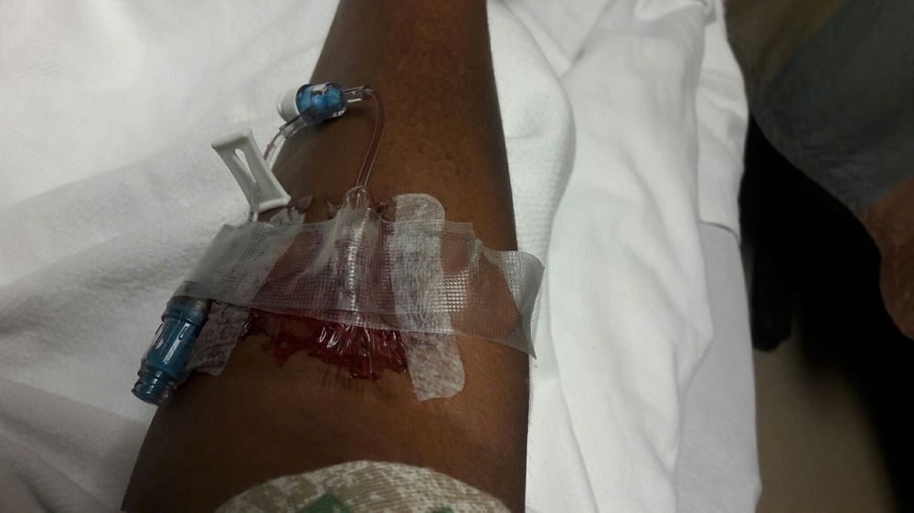 Sunrise Hospital_patient arm damaged by a blown IV