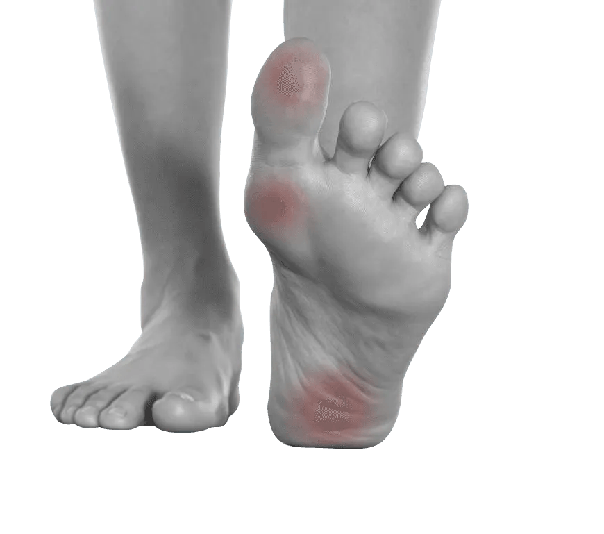 fungal bacteria site on patient's foot