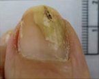 Ringworm of the Nails — Pensacola, FL — Pensacola Podiatry