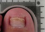 After Onychatrophia Nail Treatment — Pensacola, FL — Pensacola Podiatry