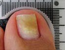 Mycotic Nails — Pensacola, FL — Pensacola Podiatry