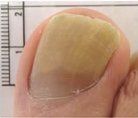 Nail with Fungal Infection — Pensacola, FL — Pensacola Podiatry