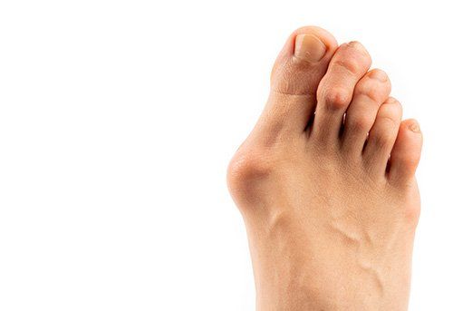 Foot with Hammertoes — Pensacola, FL — Pensacola Podiatry P.A.