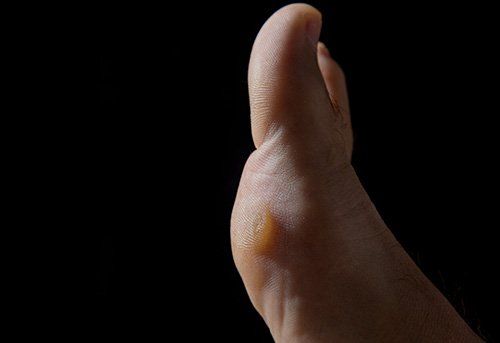 Calluses on Feet — Pensacola, FL — Pensacola Podiatry P.A.