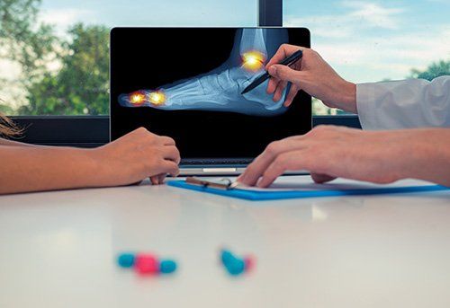 X-Ray of Foot with Gout — Pensacola, FL — Pensacola Podiatry P.A.