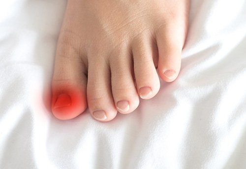 Ingrown Toenails — Pensacola, FL — Pensacola Podiatry P.A.