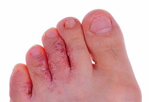 Athlete's Foot — Pensacola, FL — Pensacola Podiatry P.A.